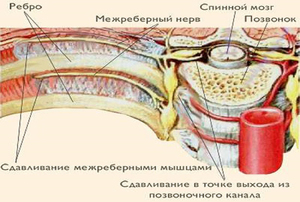 Межреберная невралгия