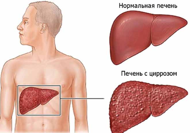 Признаки воспаления печени