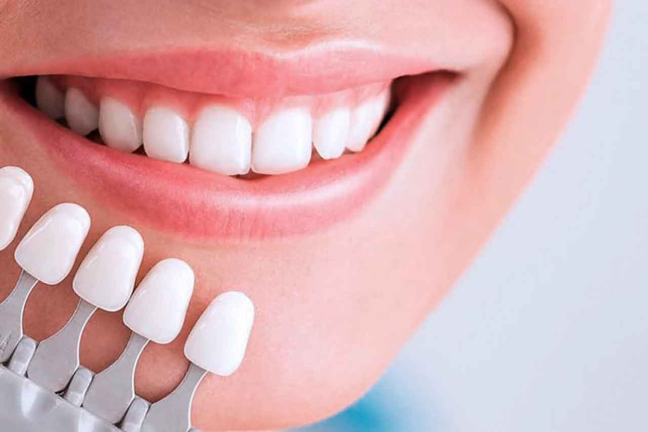 Виниры на зубы – в чем преимущества их использования?
