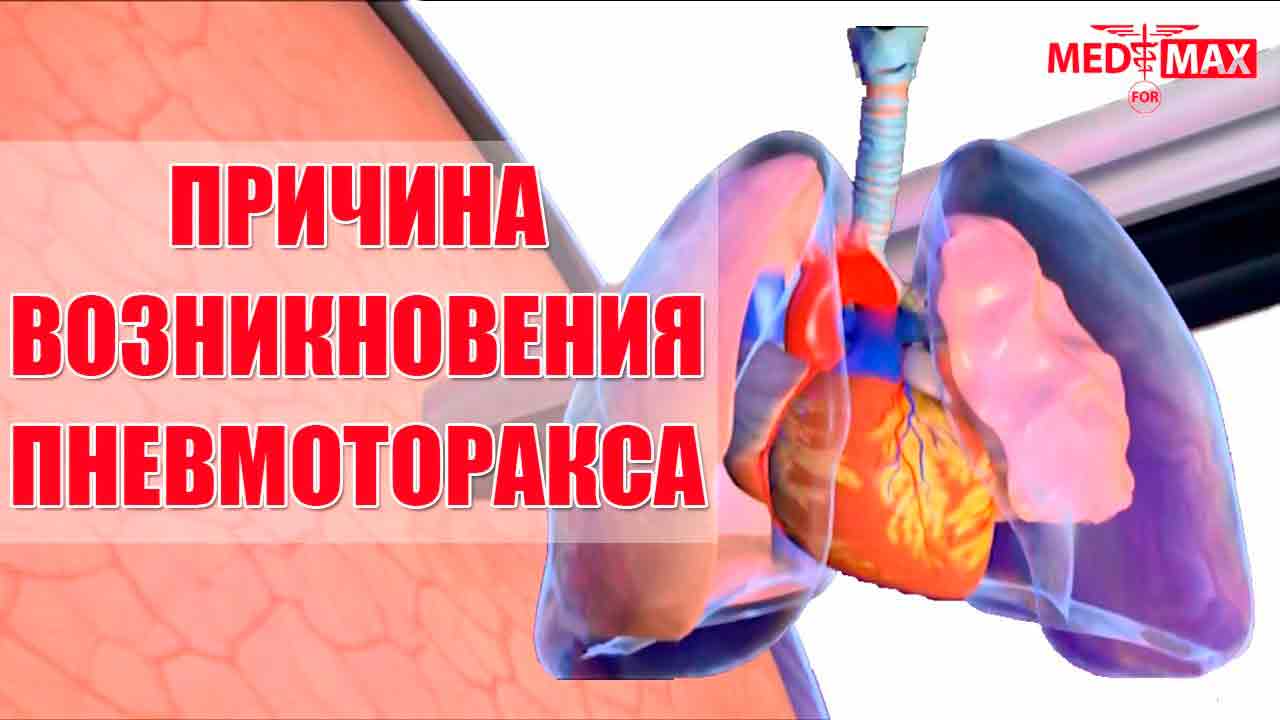 Пневмоторакс - причины, симптомы и лечение